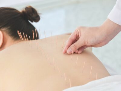 Acupuntura